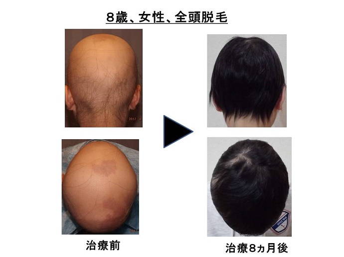 円形脱毛症　病院
